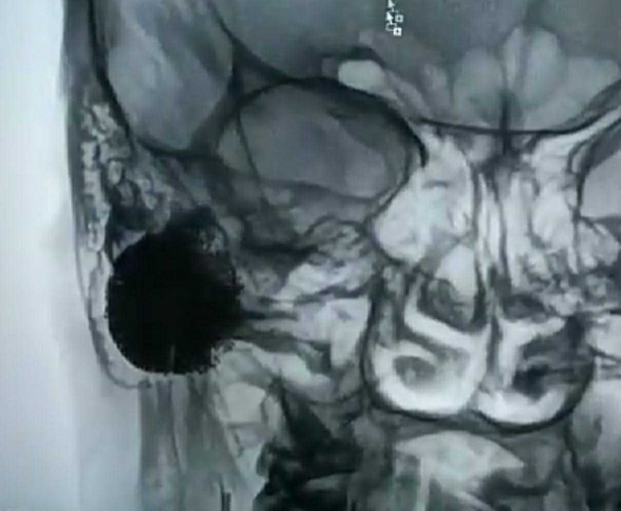 वायसीएम रुग्णालयात चेहर्‍यावरील हाडाची दुर्मिळ शस्त्रक्रिया यशस्वी