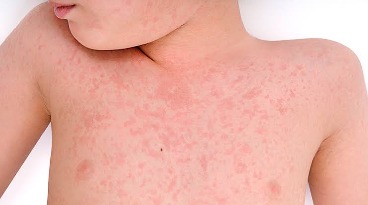 पिंपरी-चिंचवडमध्ये गोवरचे पाच रूग्ण; खबरदारी बाळगण्याचे महापालिका आयुक्तांचे आवाहन